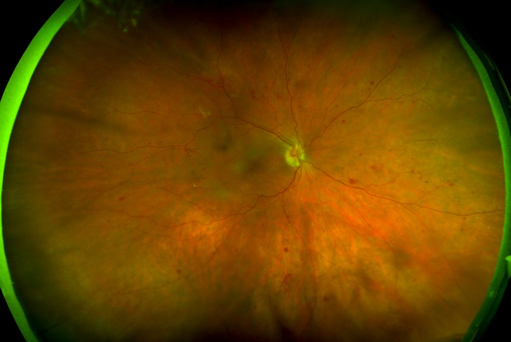 diabetic retinopathy optomap optos