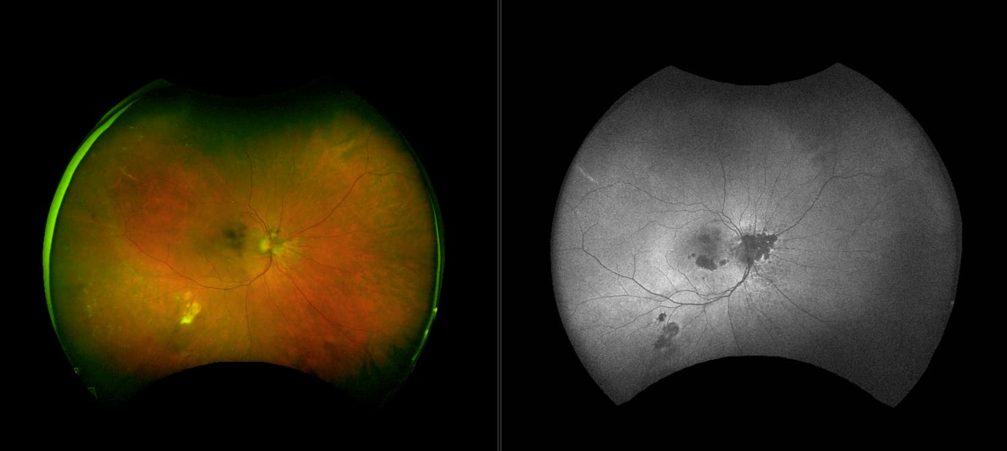 optomap color rg and optomap af with Geographic Atrophy