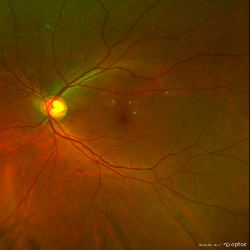 diabetic eye diseases