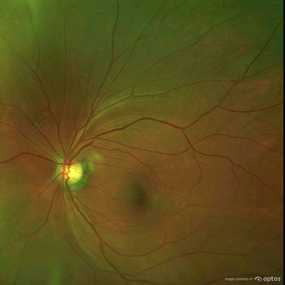 diabetic eye disease and UWF imaging
