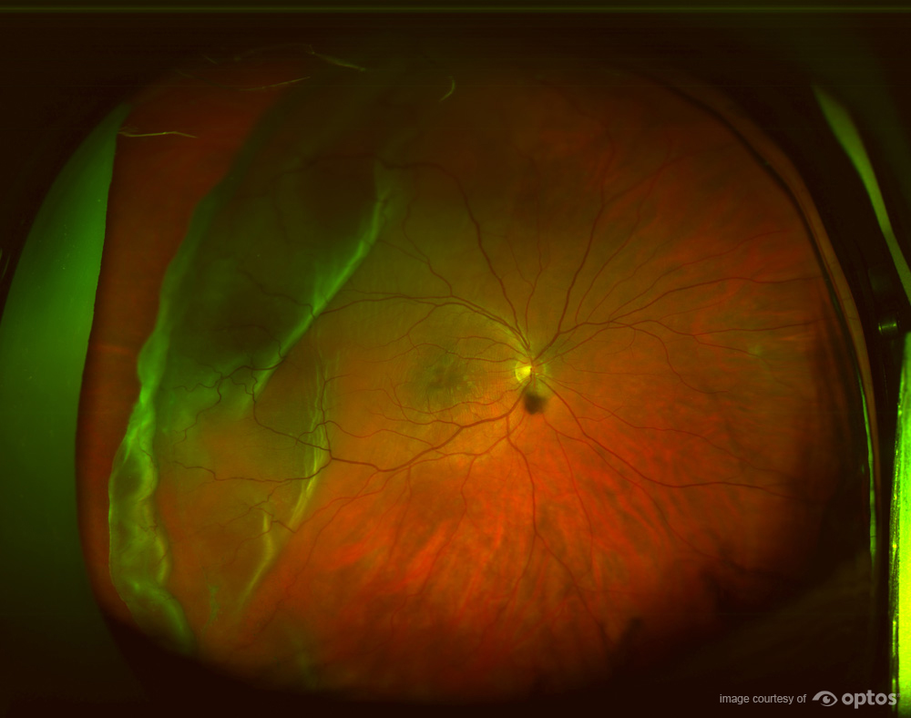 optomap image of a retinal detachment in the periphery