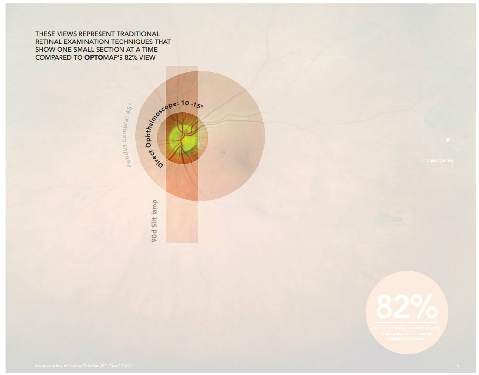 direct ophthalmoscope