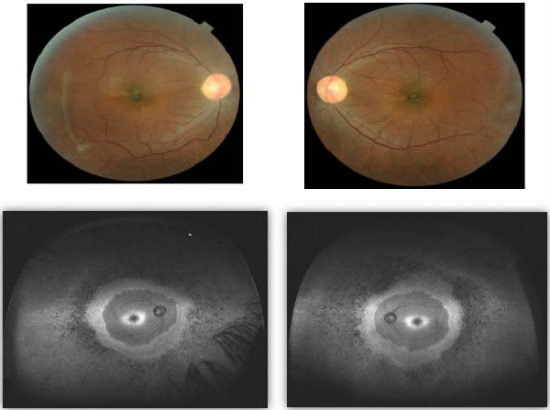 Early Retinitis Pigmentosa