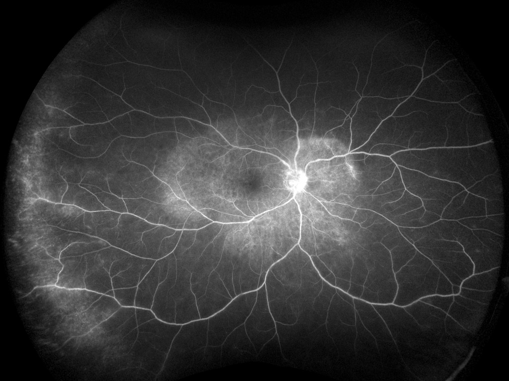 FA-Uveitis-Late-OD-California