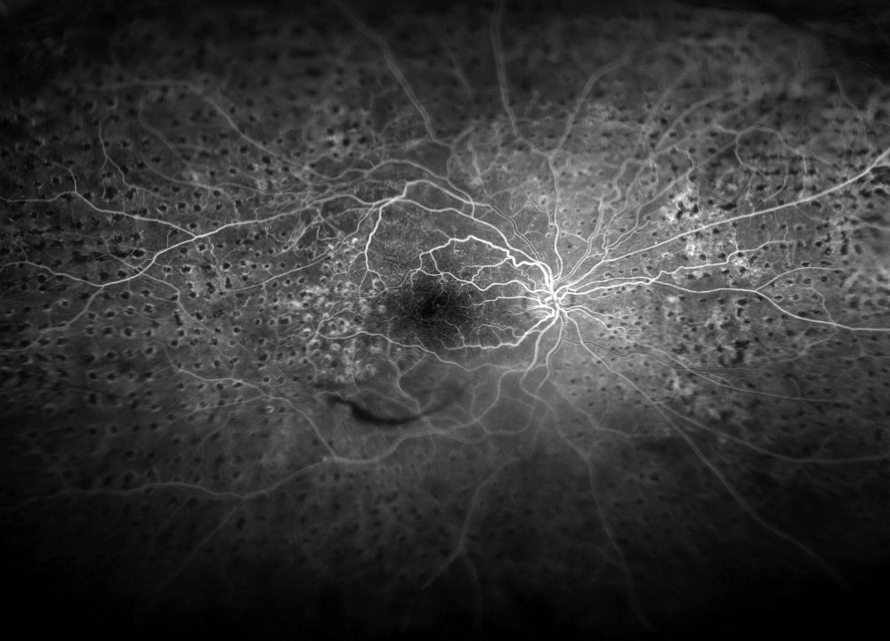 Panretinal Photocoagulation in Proliferative Diabetic Retinopathy