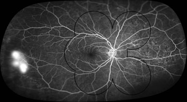 UWF retinal imaging