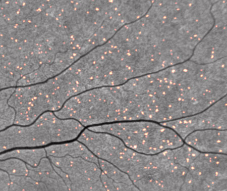 retinal imaging