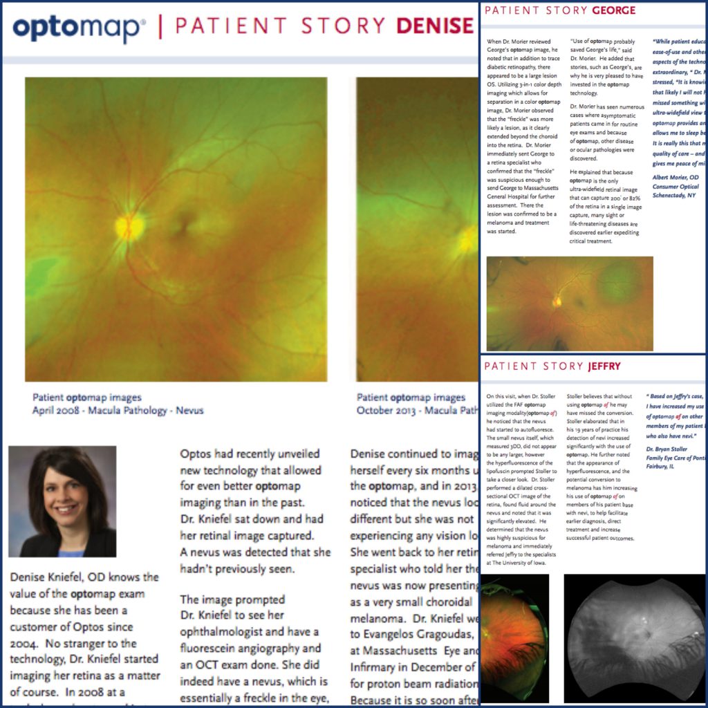 Use of UWF Imaging During Routine Eye Exams Increases the Early Detection of Choroidal Nevi