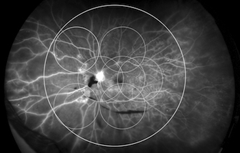 Proliferative Diabetic Retinopathy, FA, captured using the California