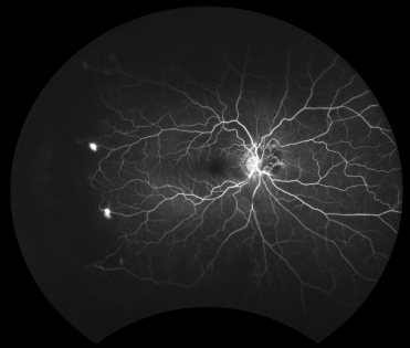 retinal image 