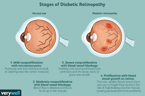 Stages of DR