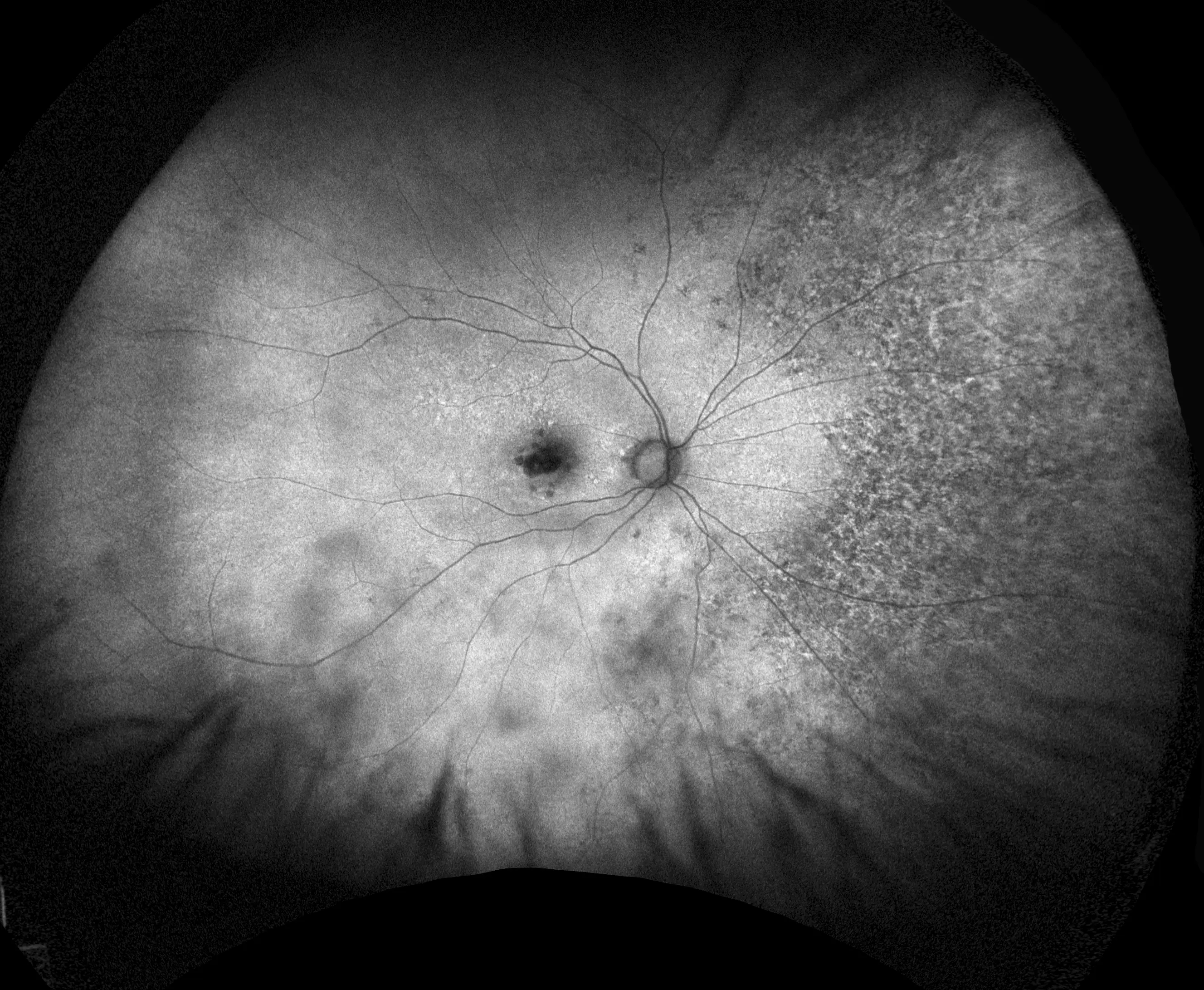 optomap af (blue laser)