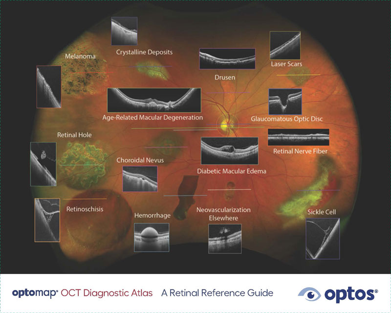 optomap icg Diagnostic Atlas