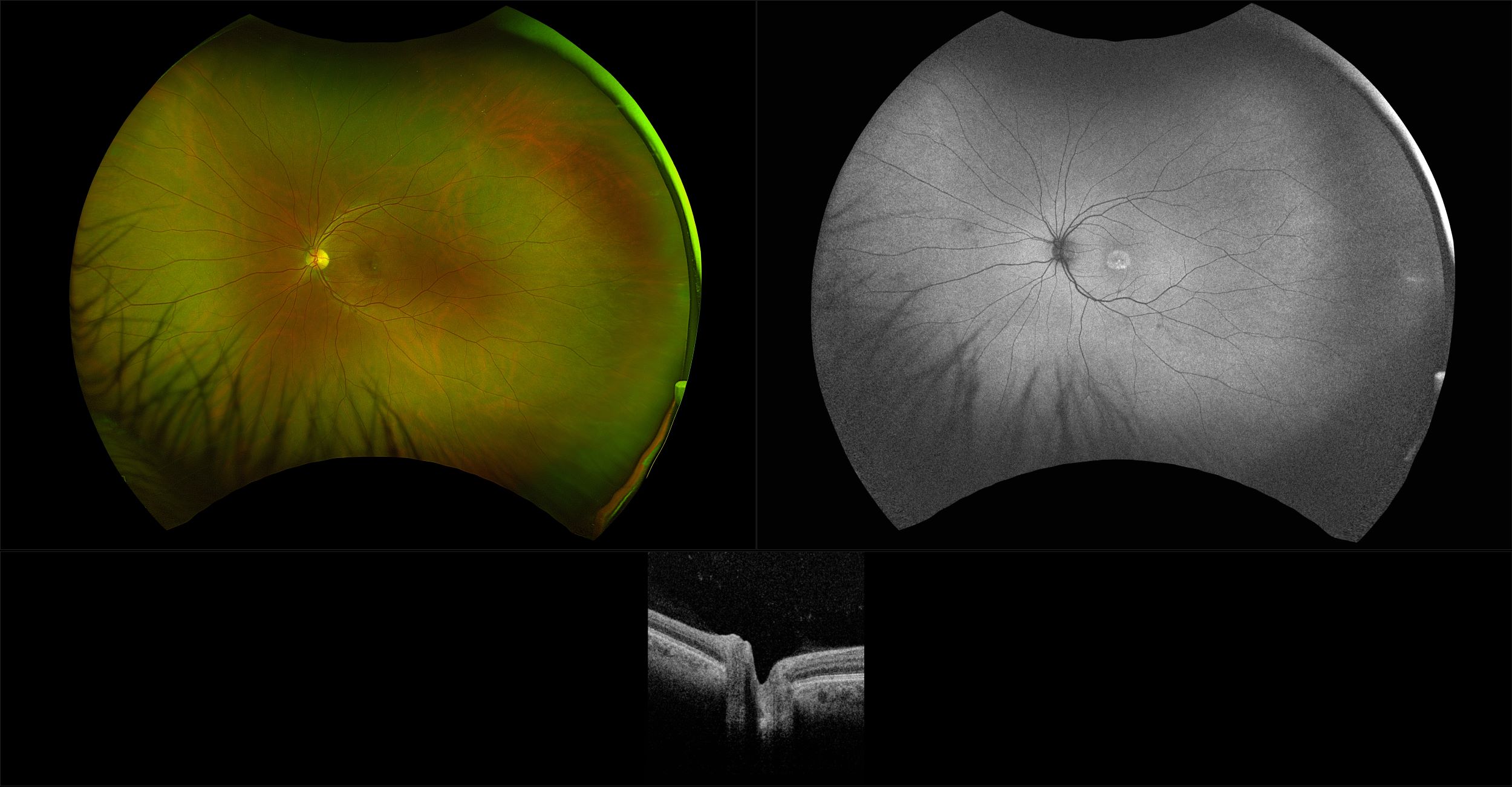 Silverstone - Central Serous Retinopathy, RG, AF, OCT