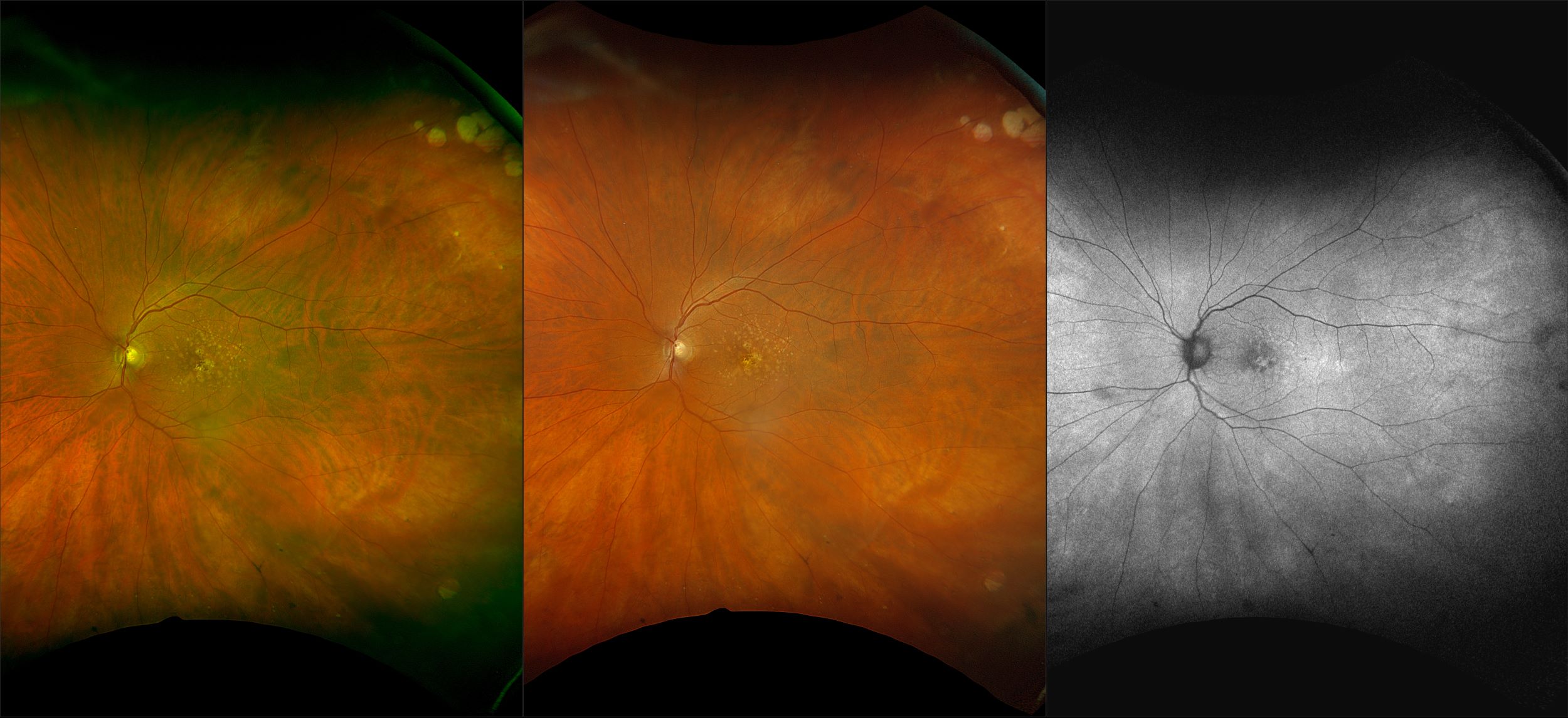 California - Early AMD with Nevus, RG, RGB, AF