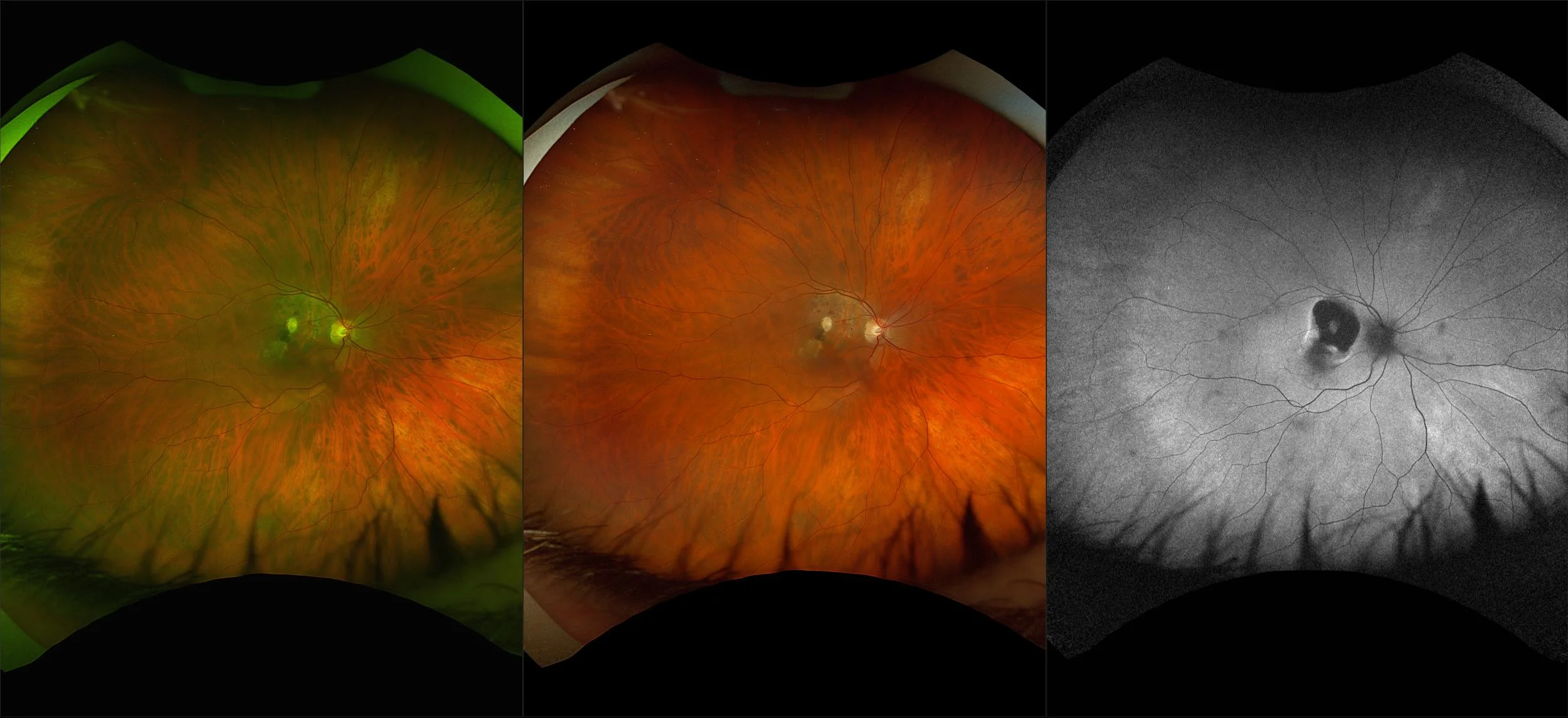 California - Chorioretinal Scarring, RG, RGB, AF