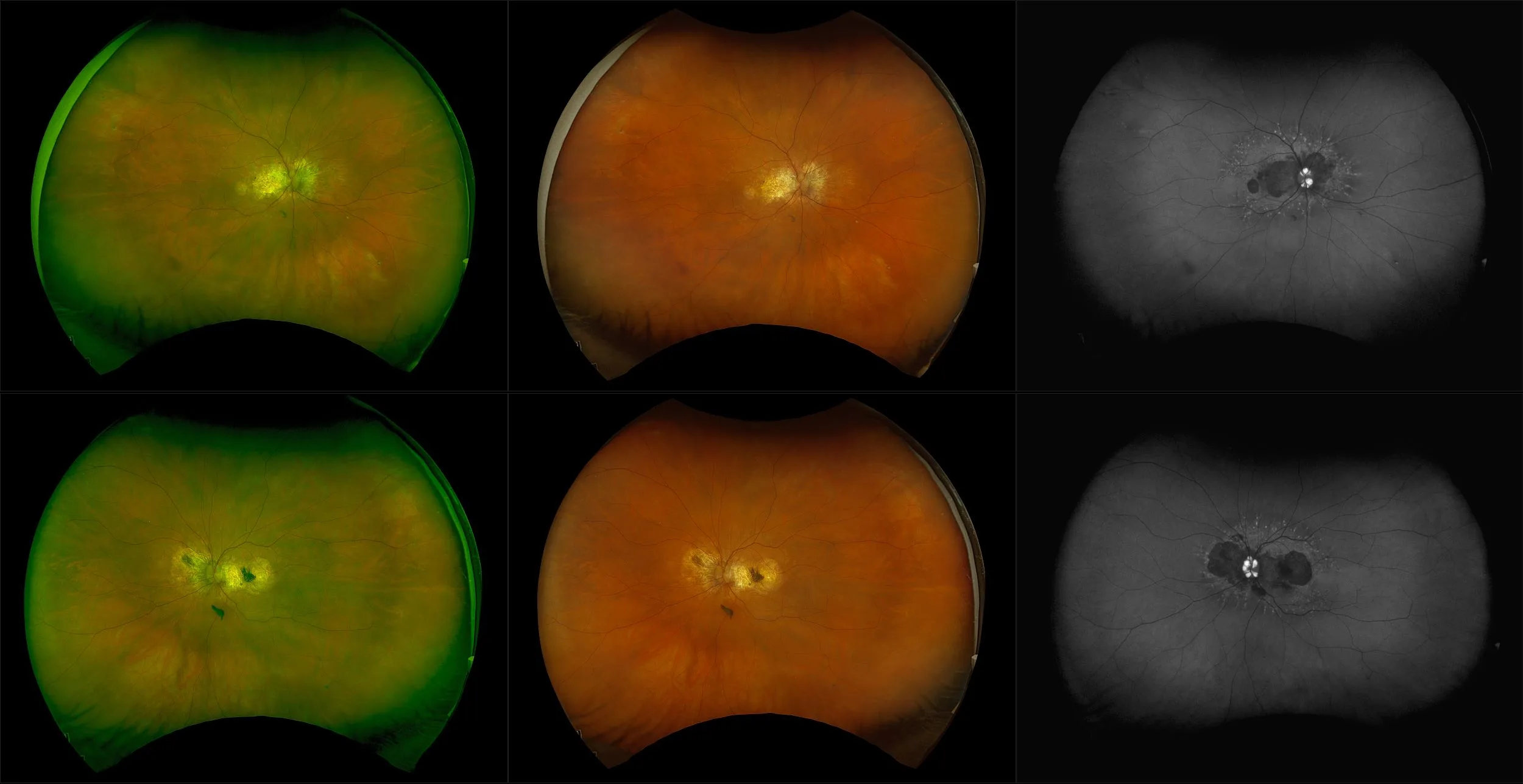 California - Retinal Neovascularization, RG, RGB, AF