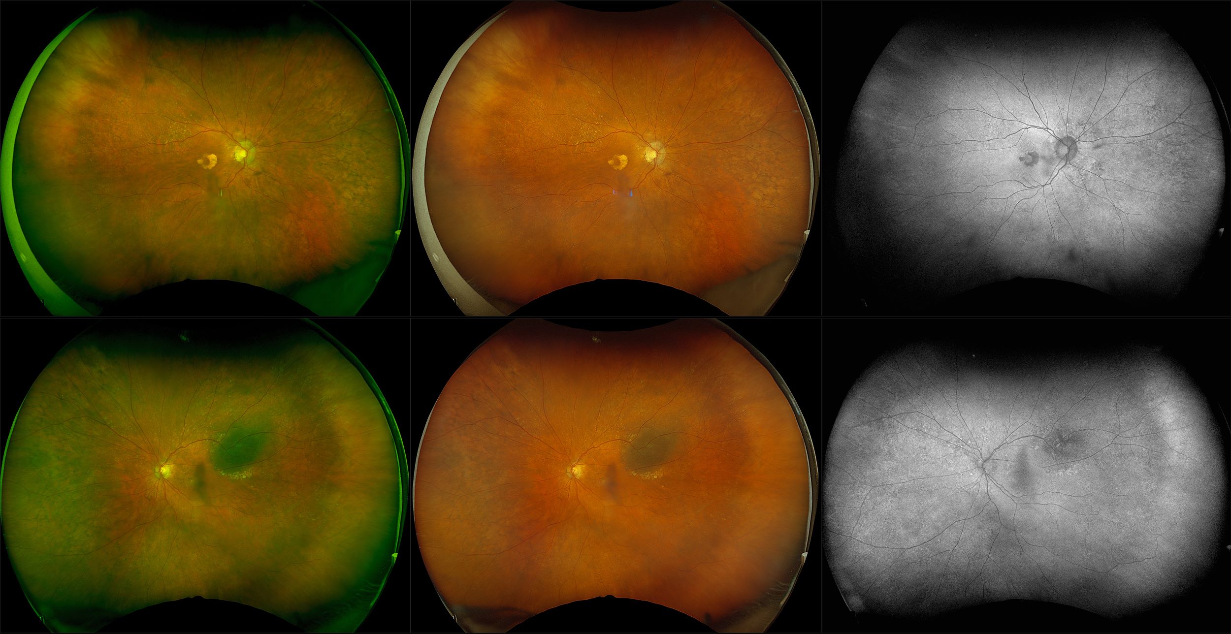 California - Intermediate Dry AMD with Benign Choroidal Nevus, RG, RGB, AF