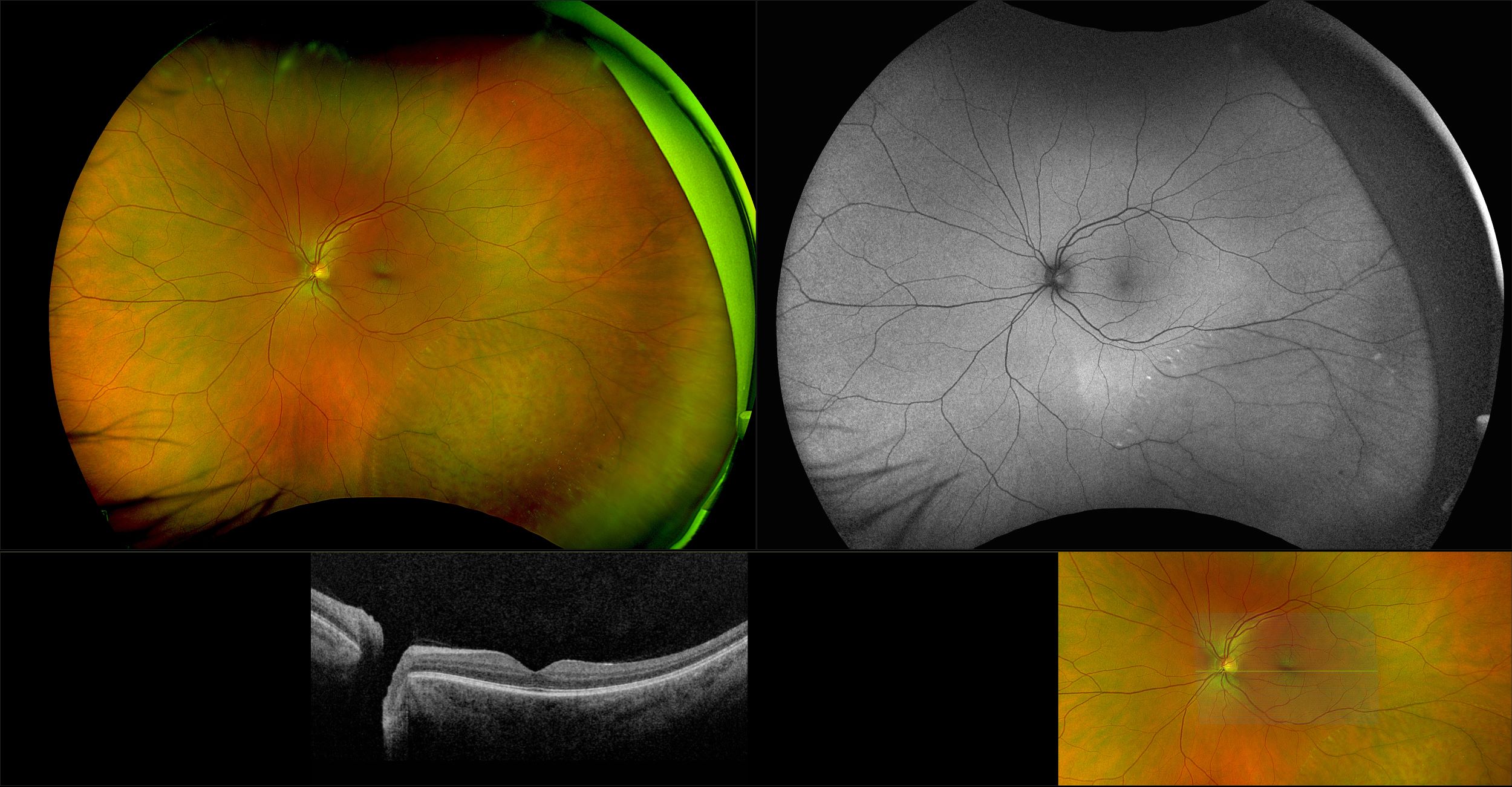 Silverstone - Peripheral Retinoschisis - RG, AF, OCT