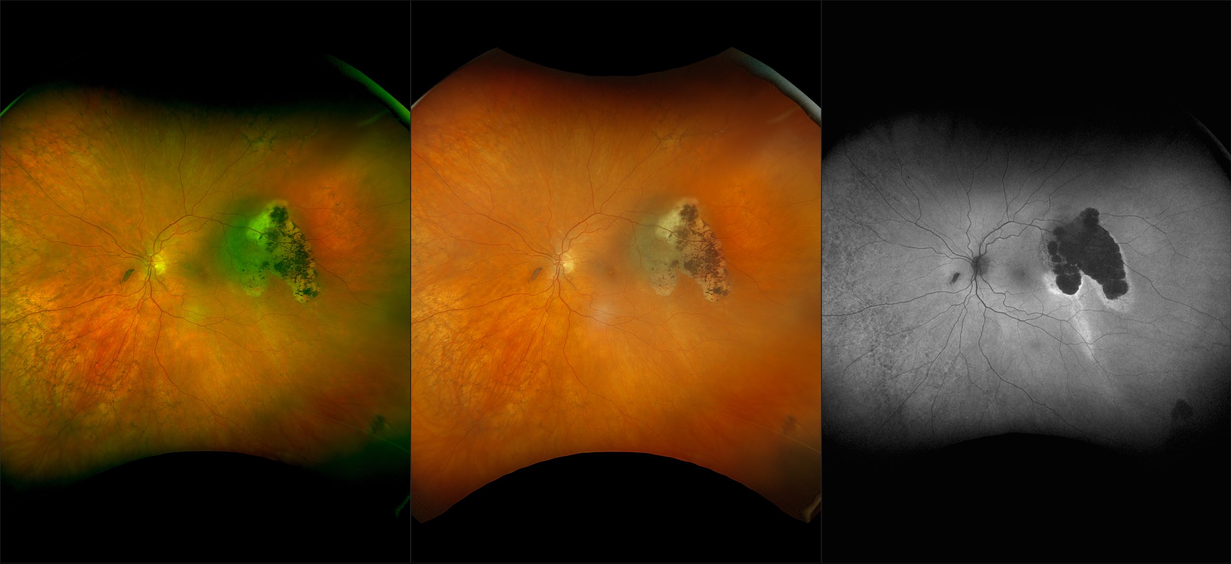 California - Choroidal Nevus, RG, RGB, AF