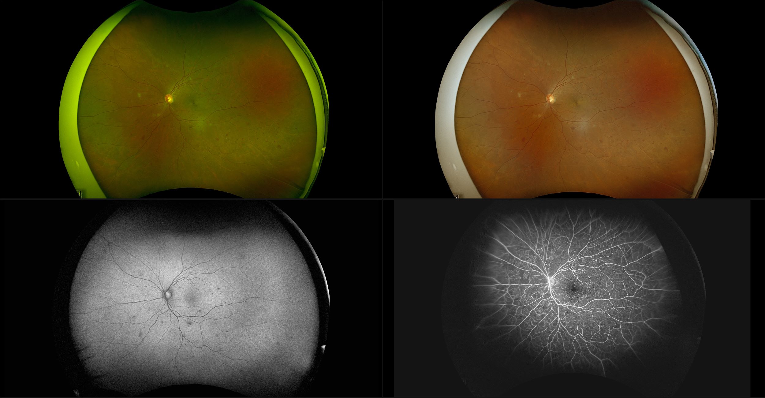 California - Proliferative Diabetic Retinopathy with NVD, RG, RGB, AF, FA