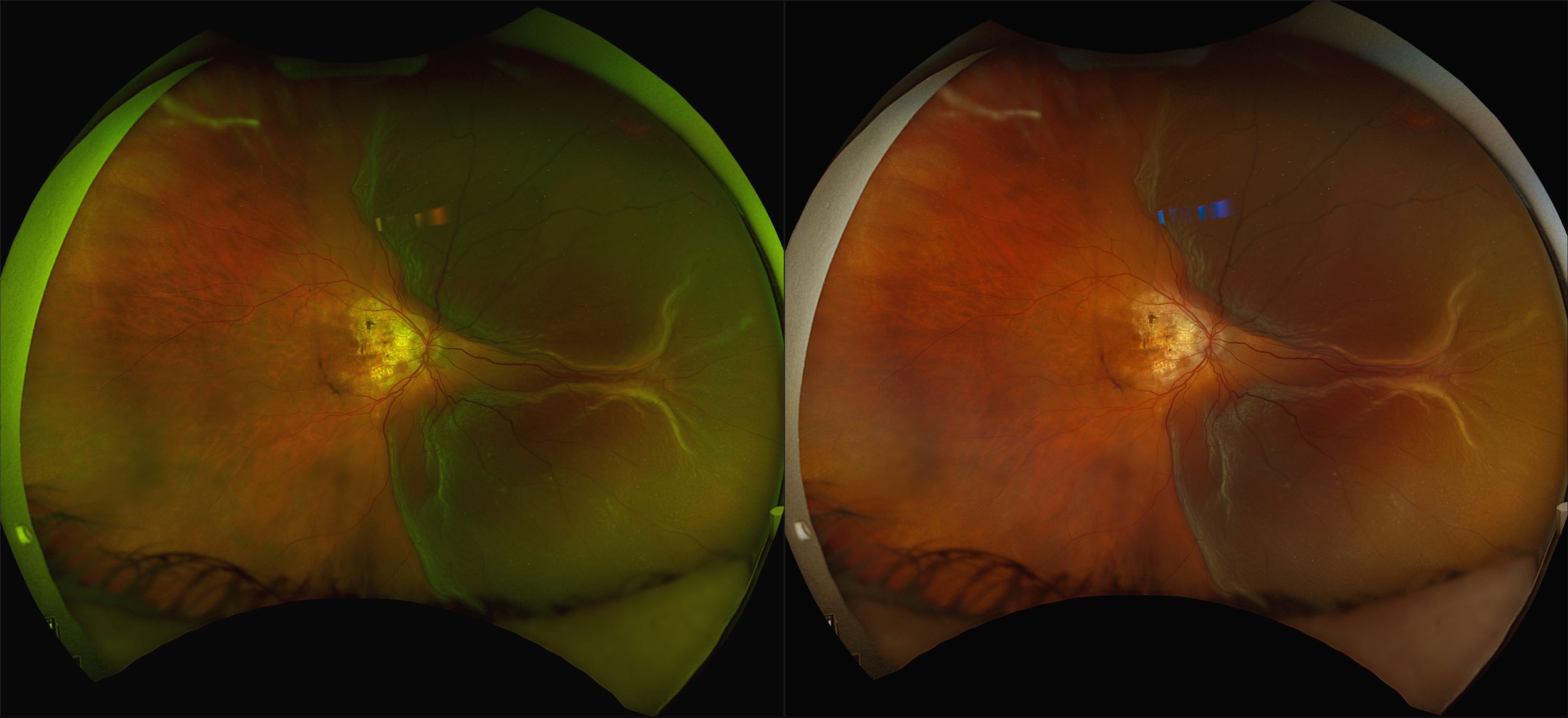 California - RD with Macular Neovascularization, RG, RGB