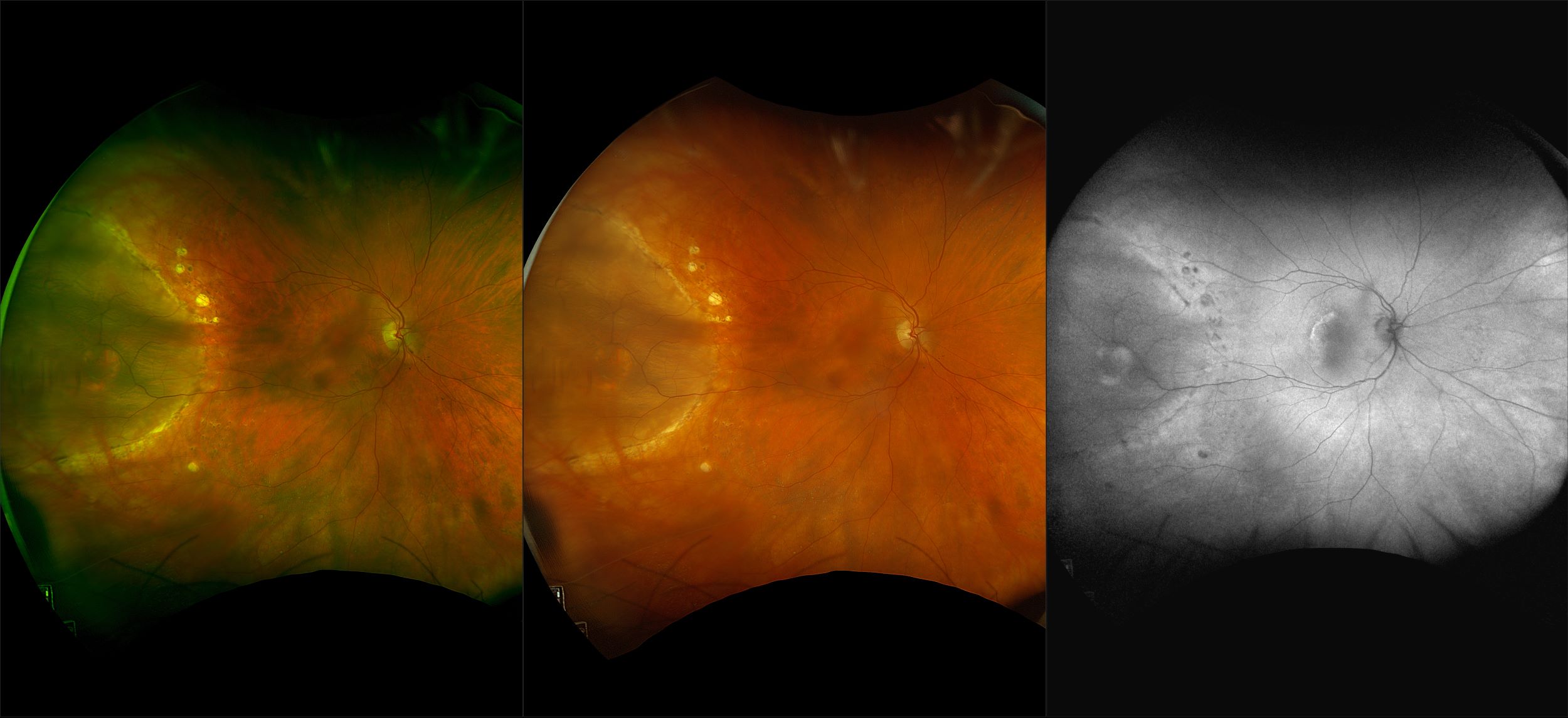 California - Wet AMD with Retinoschisis, RG, RGB, AF