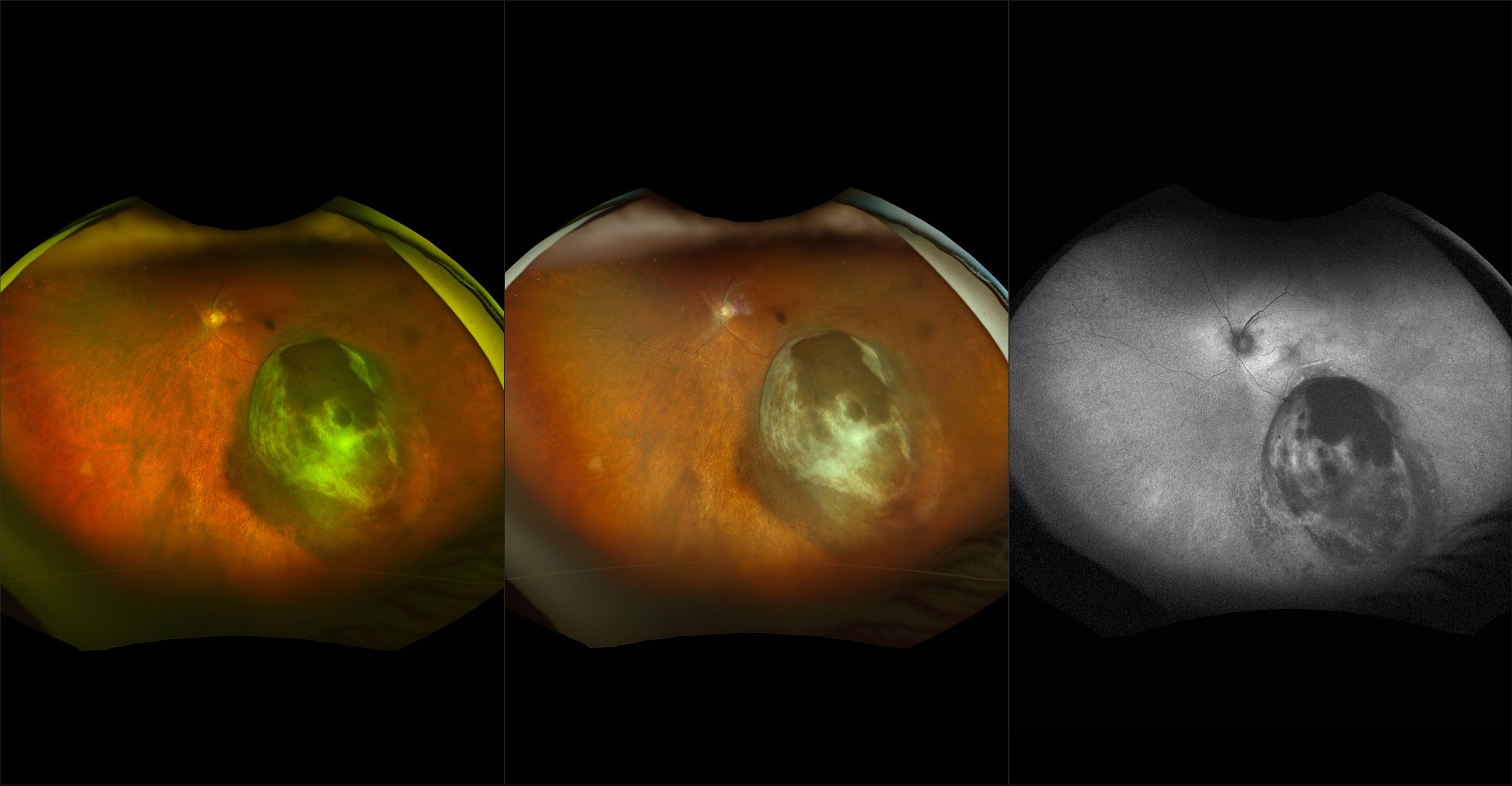 California - Choroidal Melanoma post Plaque with RVO, RG, RGB, AF