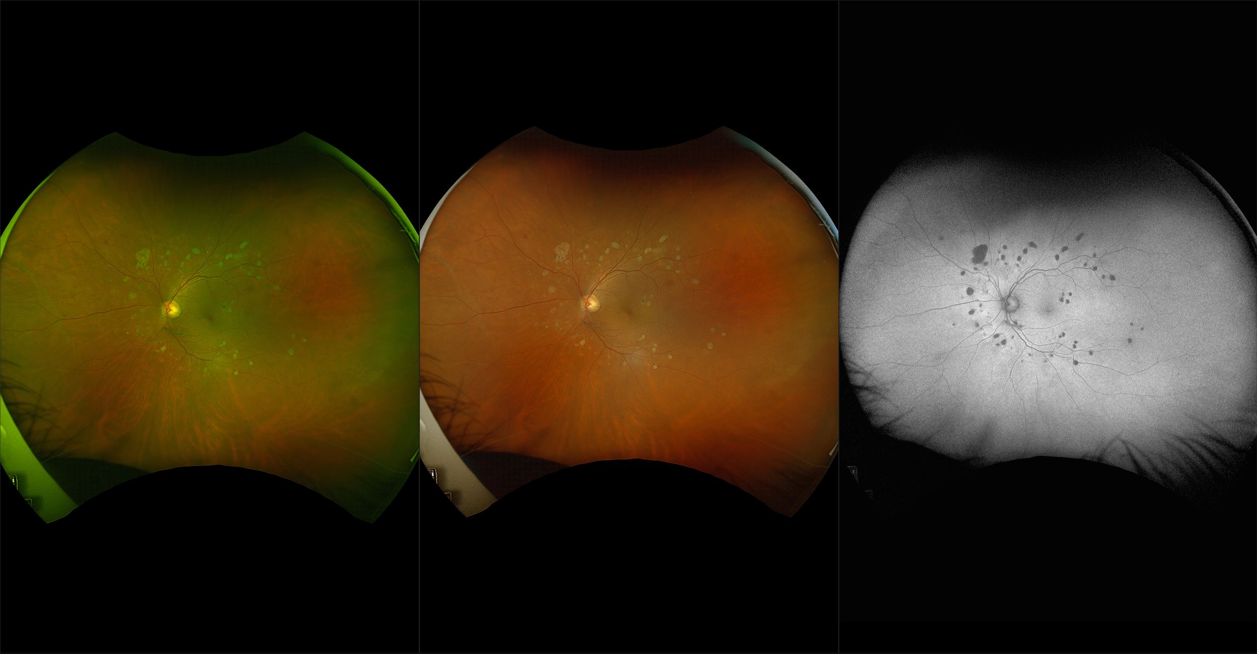 California - Dot/Blot Hemorrhage, PRP, RG, RGB, AF