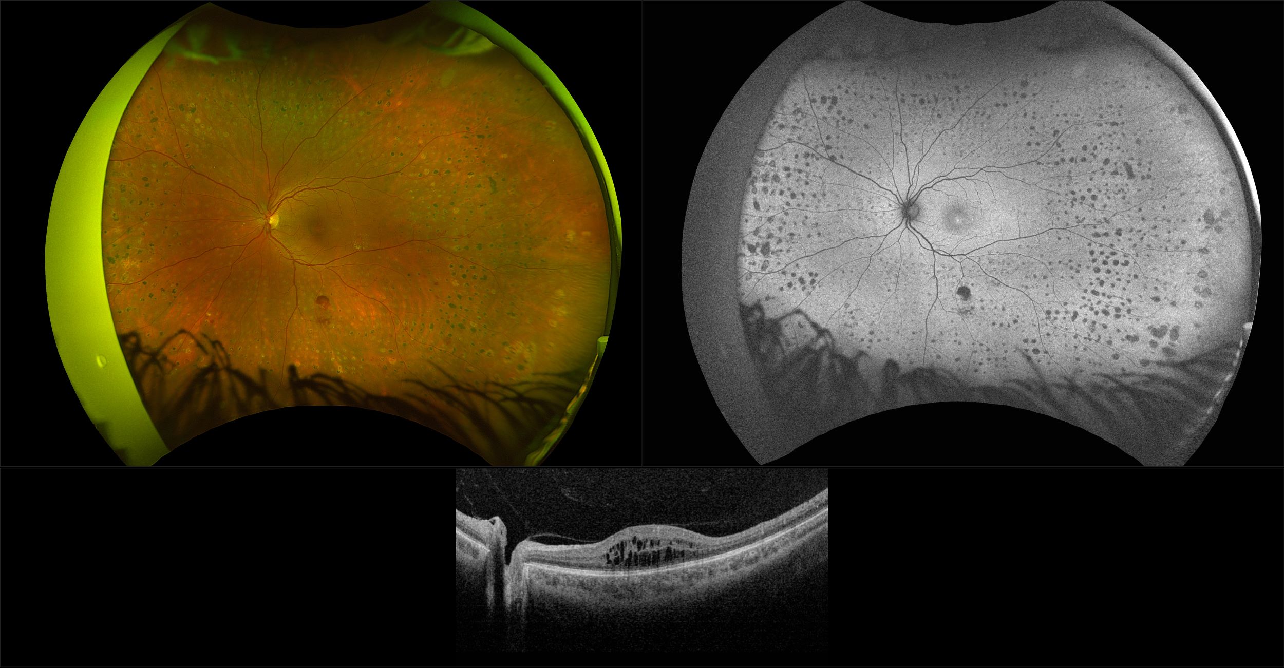 Silverstone - Proliferative Diabetic Retinopathy, RG, AF, OCT