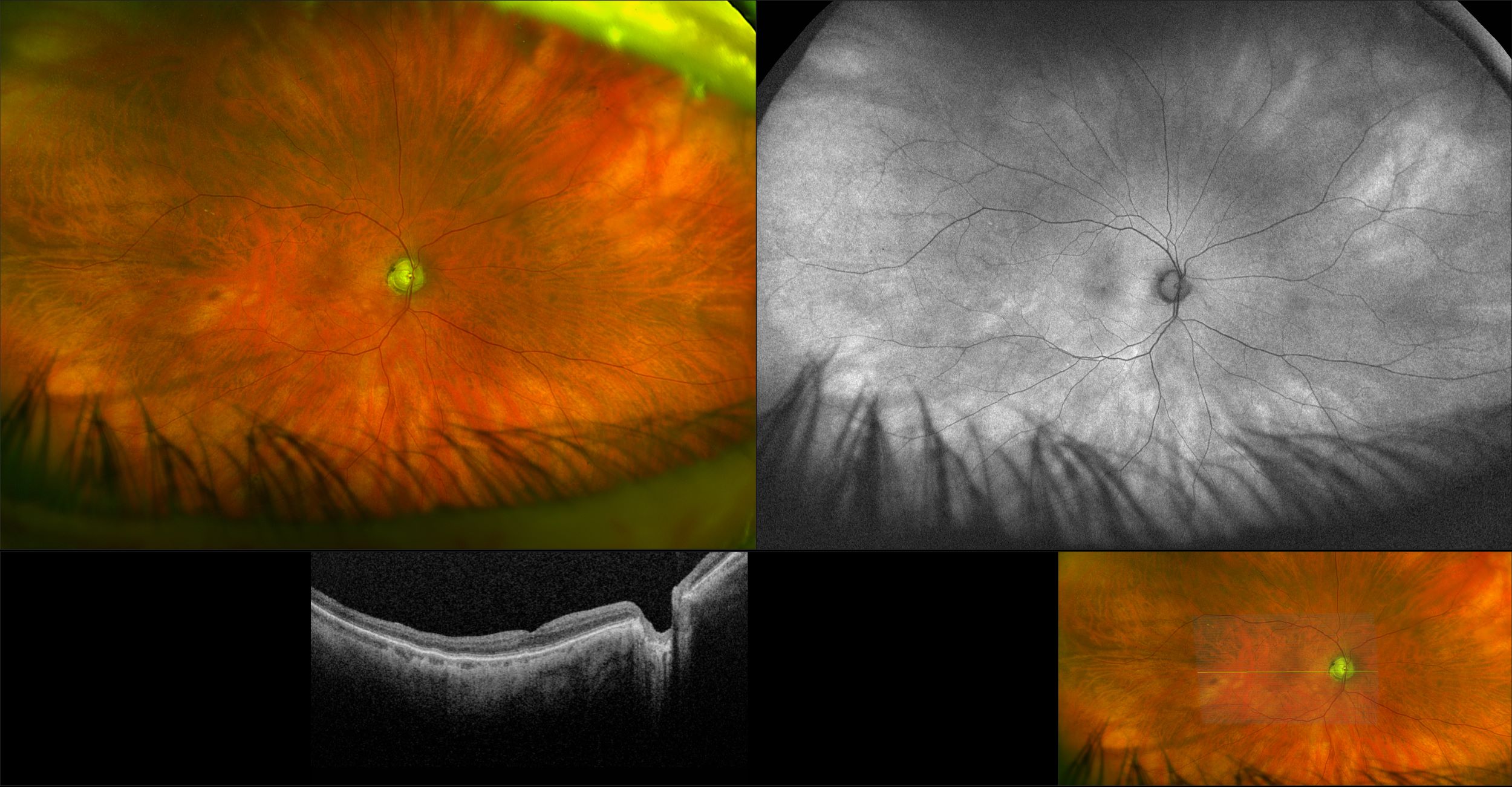 Silverstone - Retinoschisis with Foveal Attachment, RG, AF, OCT