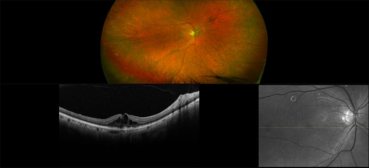 Monaco - Exudative Macular Degeneration, Post Avastin Injection, RG, OCT