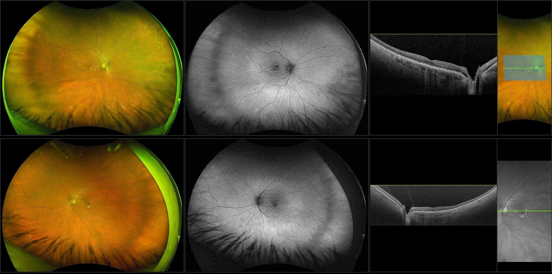 Silverstone - Dry AMD Advanced with Geographic Atrophy, RG, AF, OCT