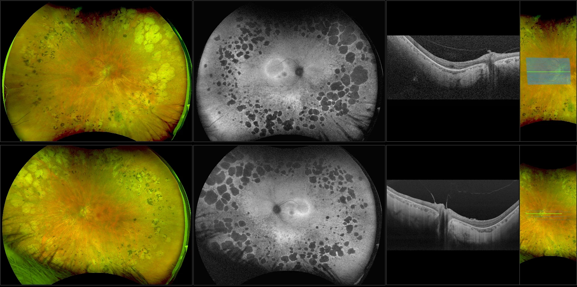 Silverstone - Retinitis Pigmentosa, RG, AF, OCT