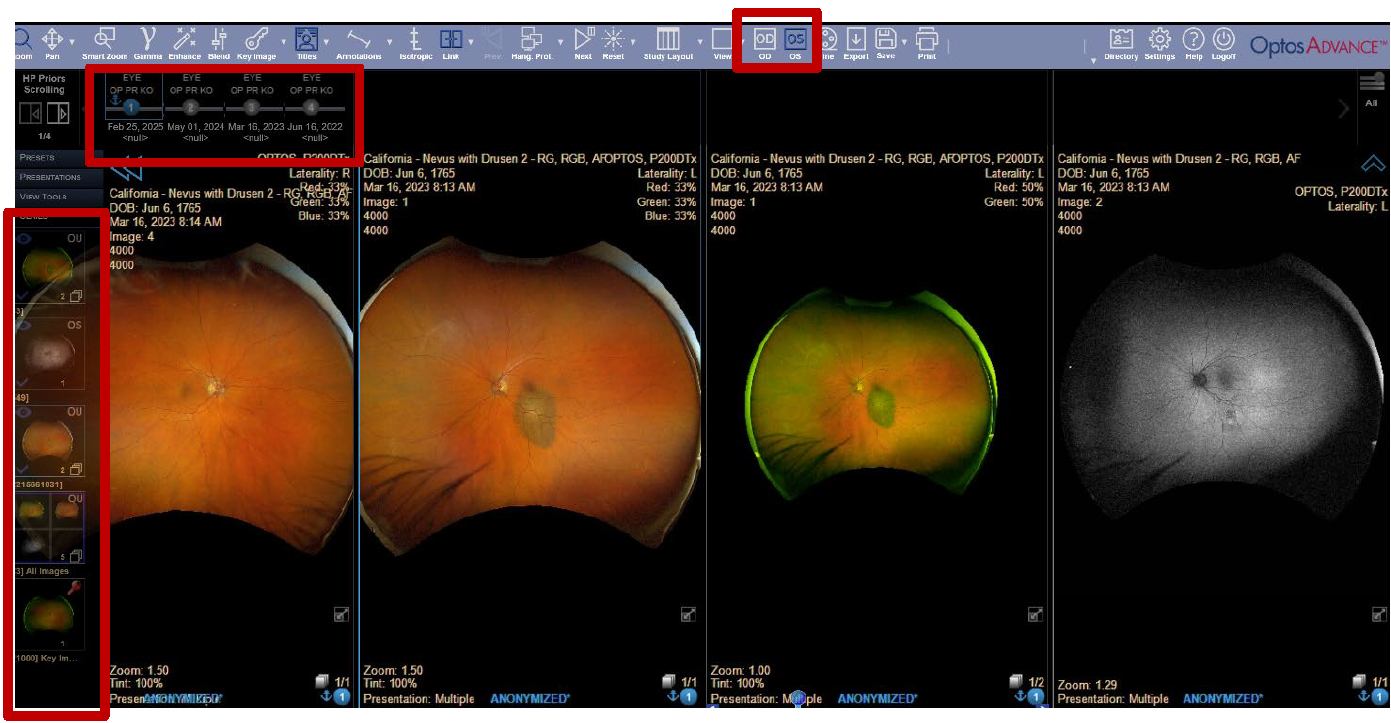 OD or OS laterality from the toolbar