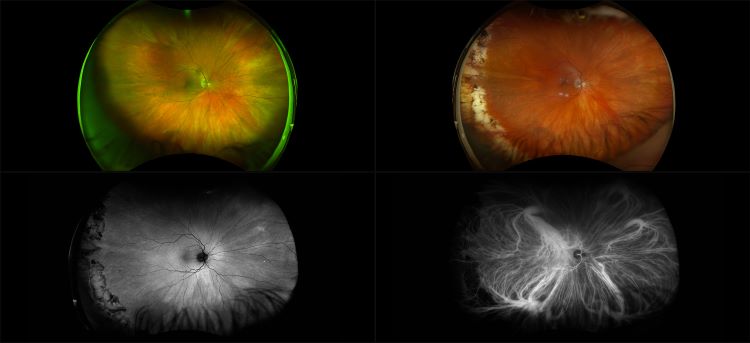 California - Central Serous Retinopathy, RG, RGB, AF, ICG