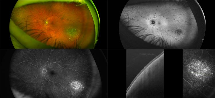 Silverstone - Nevus with Post op cataract, RG, AF, FA, OCT