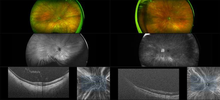 Silverstone - Wet AMD with Sub Retinal Fluid, RG, AF, FA, ICG, OCT