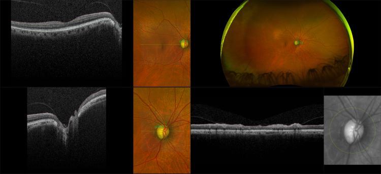 Monaco - Glaucoma, RG, OCT