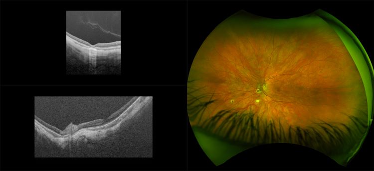 Silverstone - Posterior Vitreous Detachment, RG, OCT