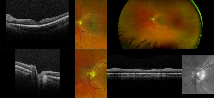 Monaco - Glaucoma, RG, OCT