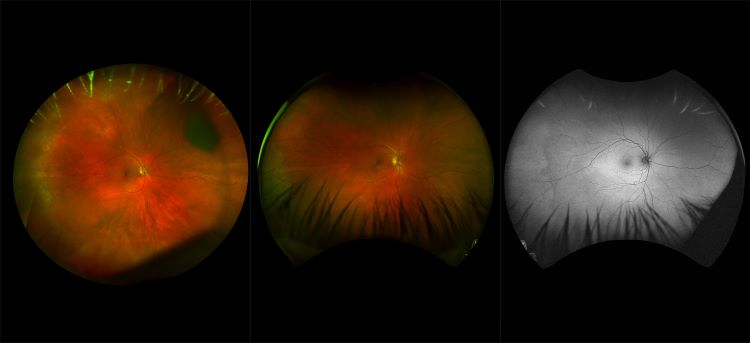 Daytona - Diabetic Retinopathy, RG, AF