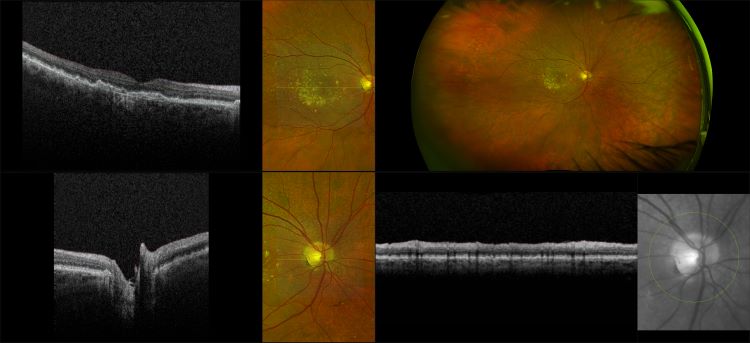 Monaco - Wet AMD with Macular Drusen and Sub-Retinal Fluid, RG, OCT