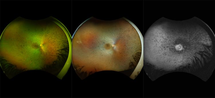 California - Retinitis Pigmentosa, RG, RGB, AF