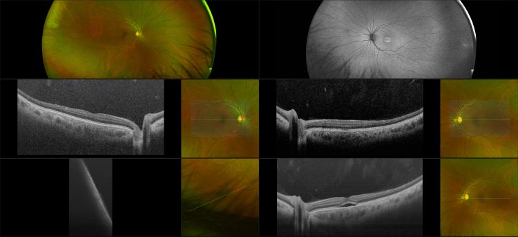 Silverstone - Central Serous Retinopathy, RG, AF, OCT