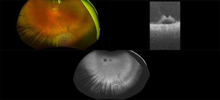 Silverstone - Retinal Hole, RG, OCT