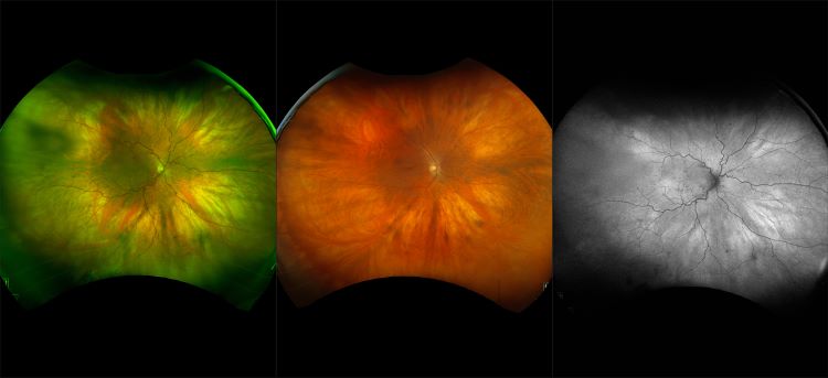 California - Retinal Vein Occlusion, RG, AF, FA, ICG