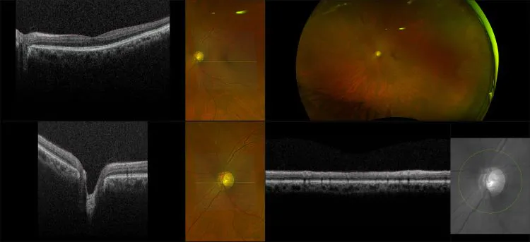 Monaco - Advanced  Glaucoma, RG, OCT