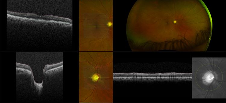 Monaco - Glaucoma with Deep Cup, RG, OCT