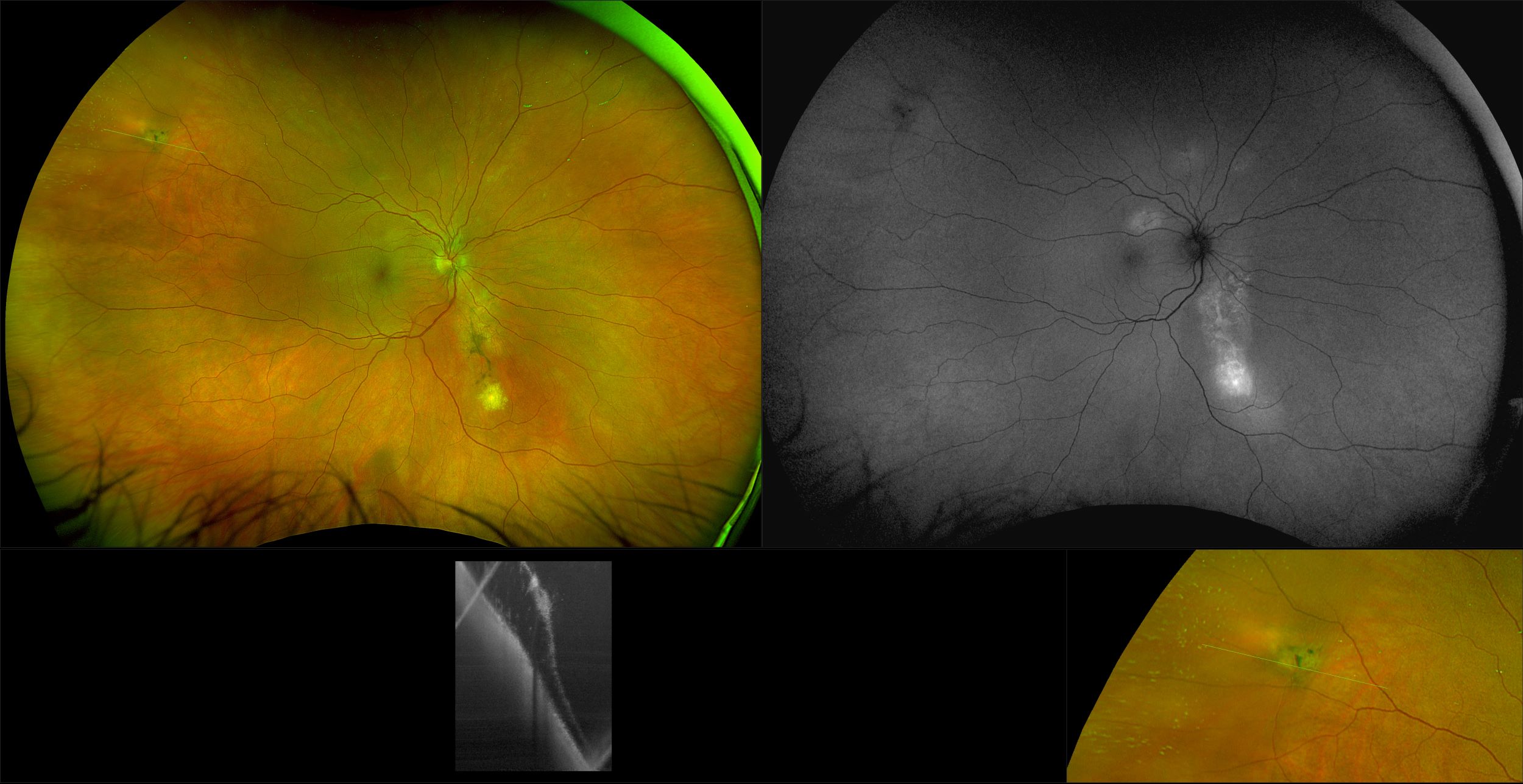 Silverstone - Central Serous with Schisis and Amaurosis Fugax, RG, AF